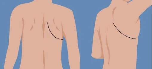 incision1