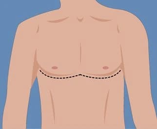 incision3