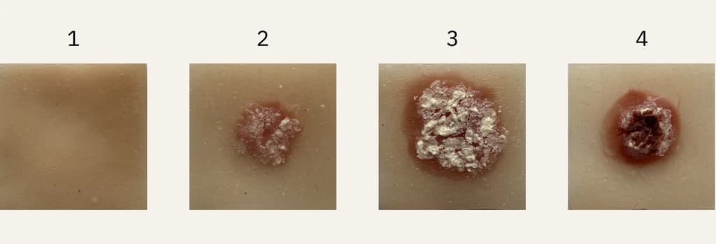 SCC (progression)